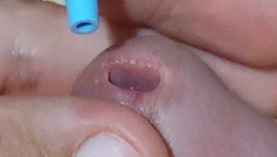 Applying Minoxidil for vein dilation directly on the glans.