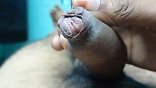 Phimosis and peyronies disease